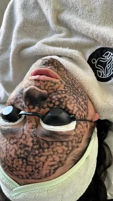 Rostro con mascarilla de carbón y lentes de protección para Hollywood Peel